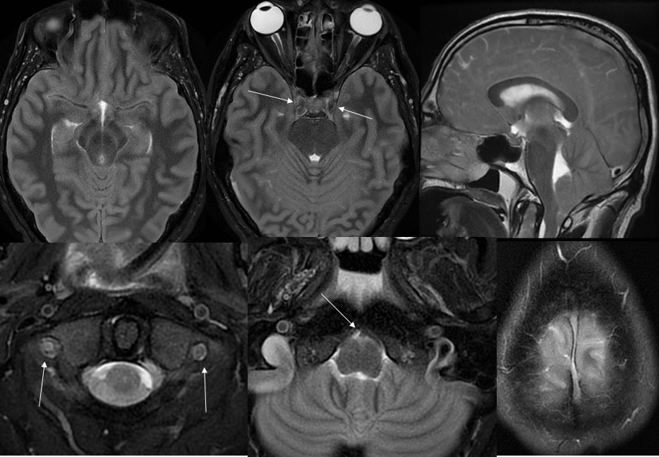 diffuse anoxic injur